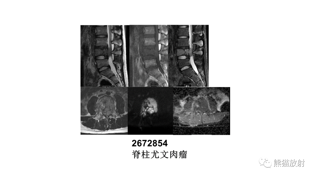 影像PPT - 【病例】椎体恶性外周神经鞘瘤 VS 浆细胞瘤-38
