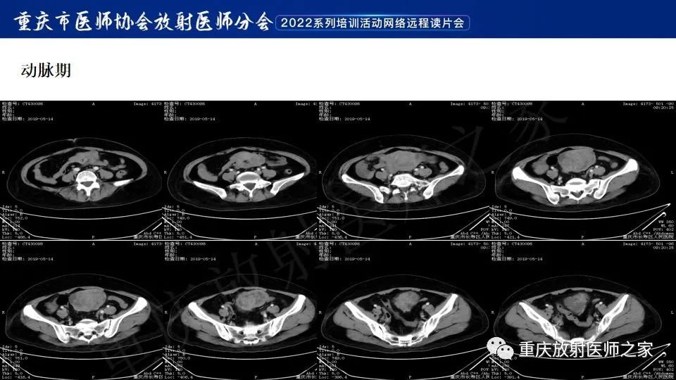 影像PPT - 【病例】小肠胃肠道间质瘤1例CT影像-4