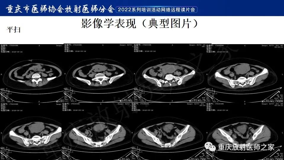 影像PPT - 【病例】小肠胃肠道间质瘤1例CT影像-3
