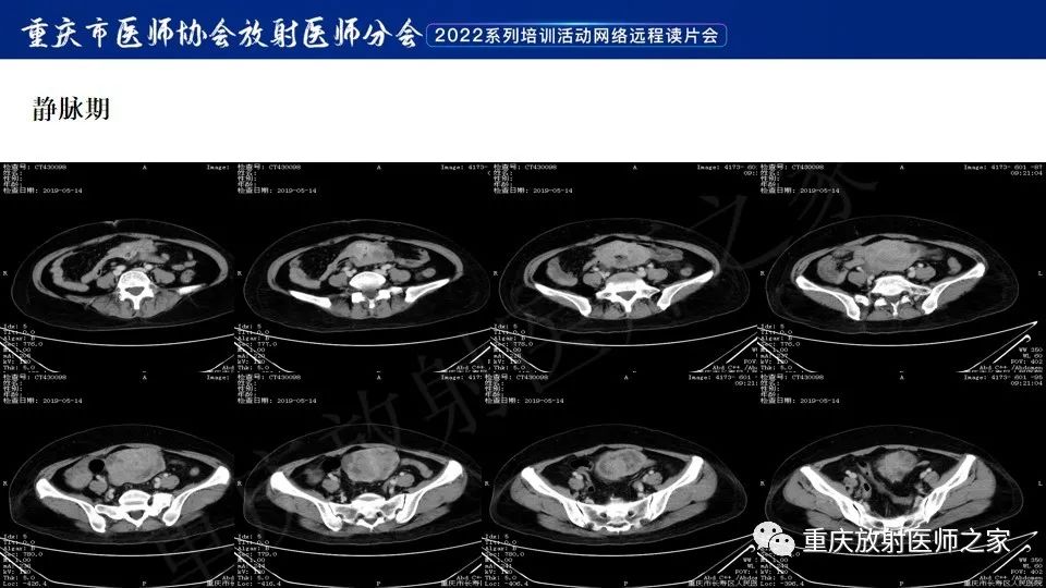 影像PPT - 【病例】小肠胃肠道间质瘤1例CT影像-5