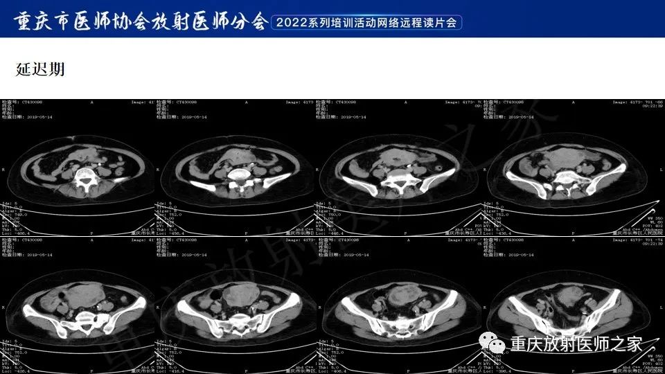 影像PPT - 【病例】小肠胃肠道间质瘤1例CT影像-6