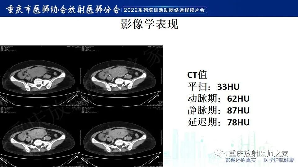 影像PPT - 【病例】小肠胃肠道间质瘤1例CT影像-7