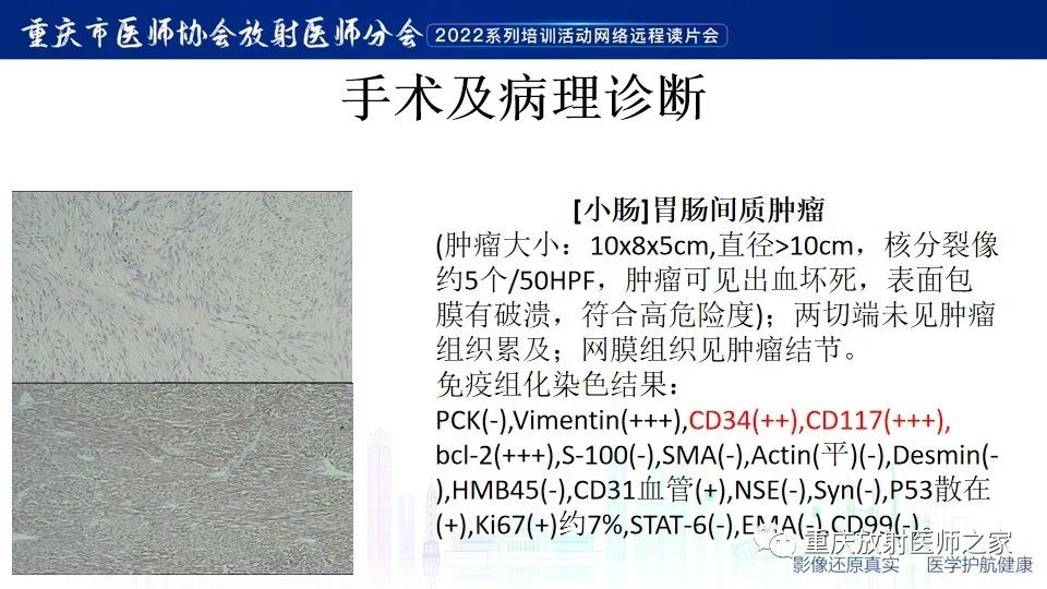 影像PPT - 【病例】小肠胃肠道间质瘤1例CT影像-10