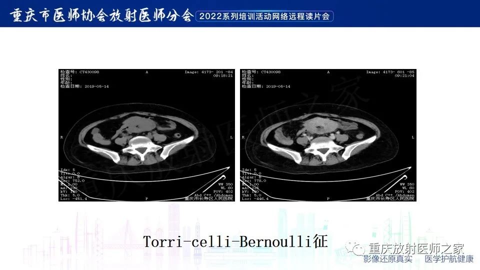 影像PPT - 【病例】小肠胃肠道间质瘤1例CT影像-15