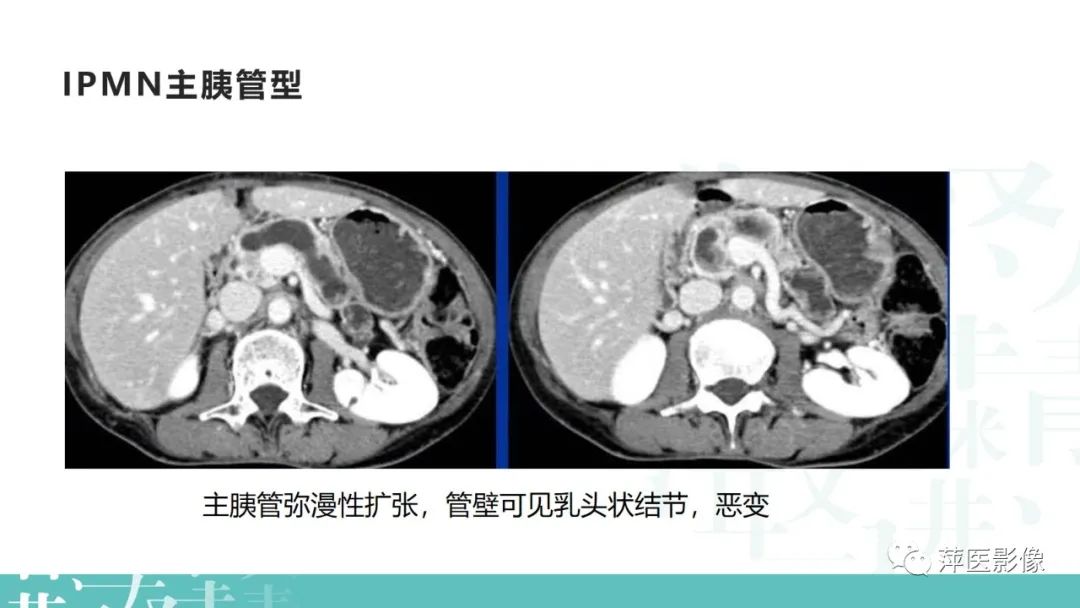 影像PPT - 【PPT】胰腺囊性肿瘤中的“老爷子”（IPMN）及诊断思路-9