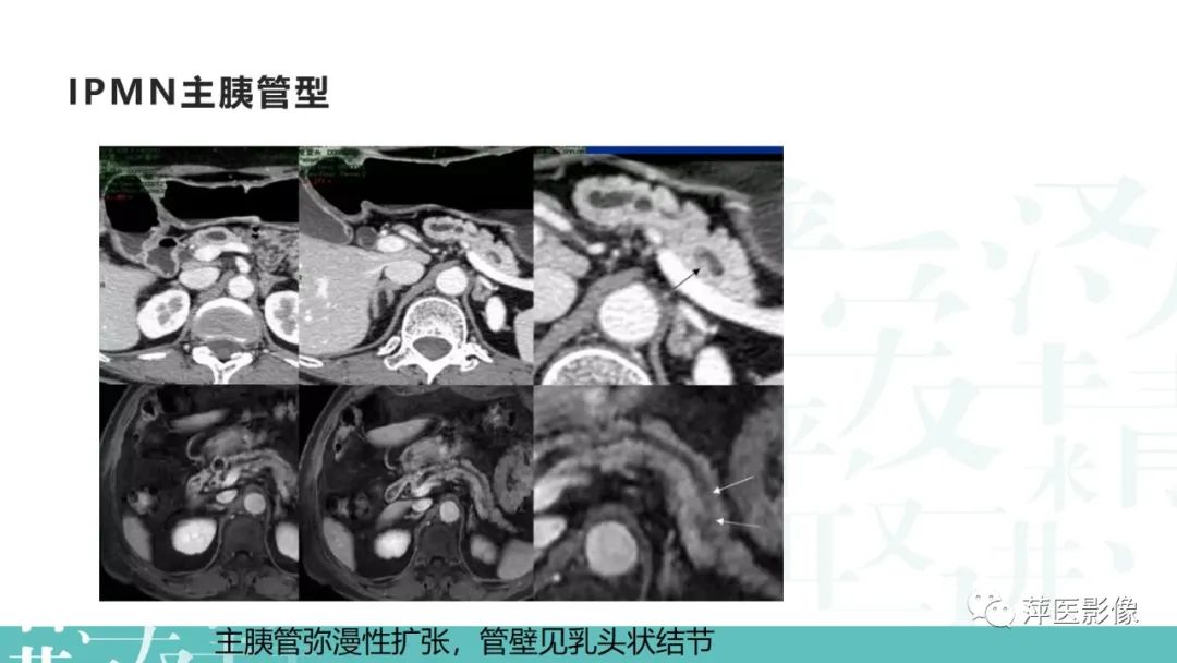 影像PPT - 【PPT】胰腺囊性肿瘤中的“老爷子”（IPMN）及诊断思路-10