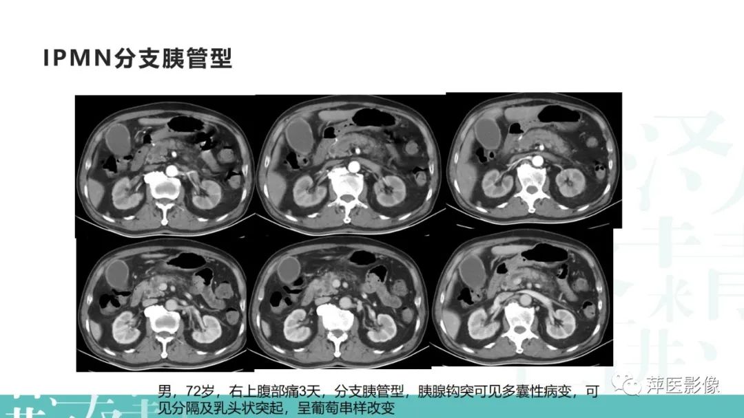 影像PPT - 【PPT】胰腺囊性肿瘤中的“老爷子”（IPMN）及诊断思路-11
