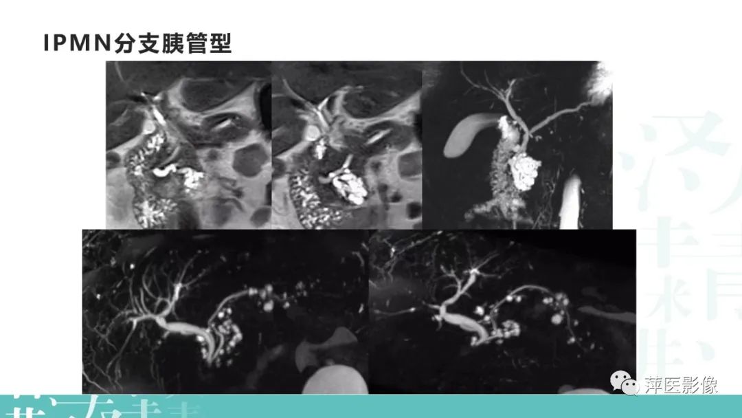 影像PPT - 【PPT】胰腺囊性肿瘤中的“老爷子”（IPMN）及诊断思路-12