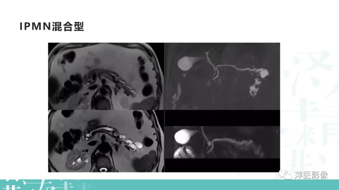 影像PPT - 【PPT】胰腺囊性肿瘤中的“老爷子”（IPMN）及诊断思路-13