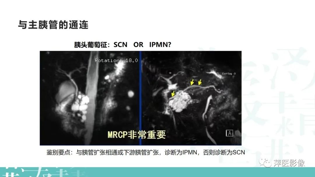 影像PPT - 【PPT】胰腺囊性肿瘤中的“老爷子”（IPMN）及诊断思路-18