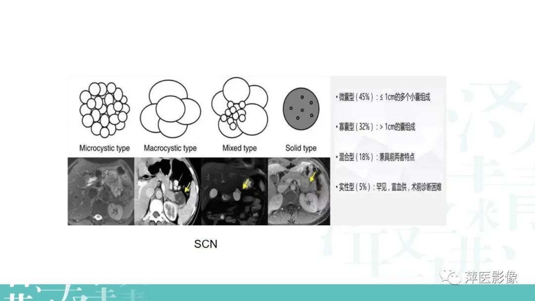 影像PPT - 【PPT】胰腺囊性肿瘤中的“老爷子”（IPMN）及诊断思路-24