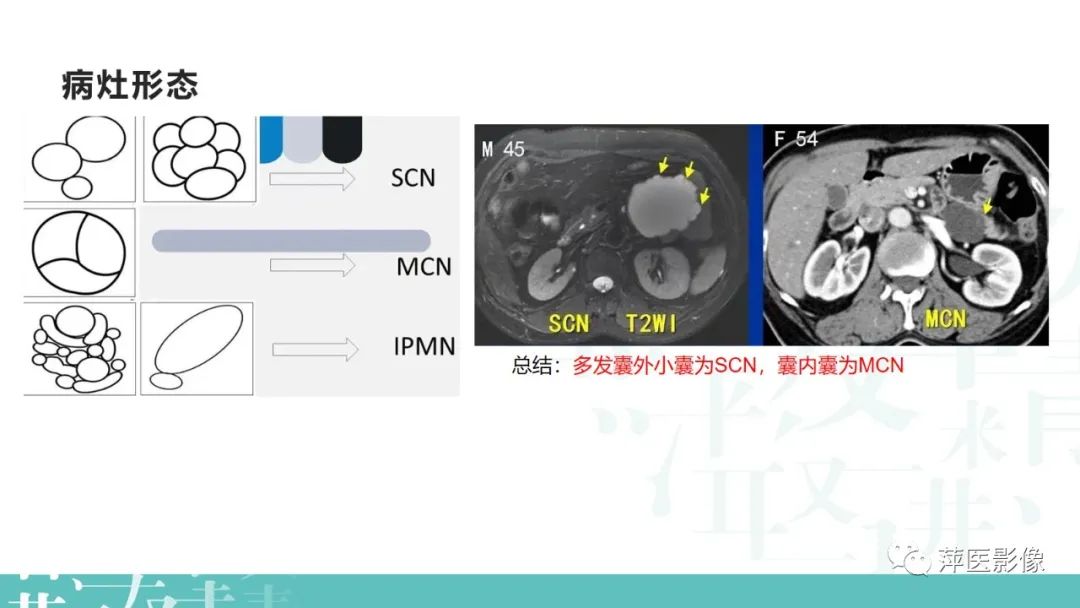 影像PPT - 【PPT】胰腺囊性肿瘤中的“老爷子”（IPMN）及诊断思路-25