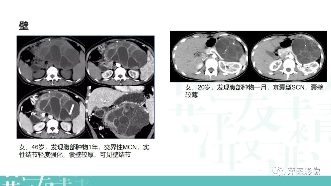 影像PPT - 【PPT】胰腺囊性肿瘤中的“老爷子”（IPMN）及诊断思路-28