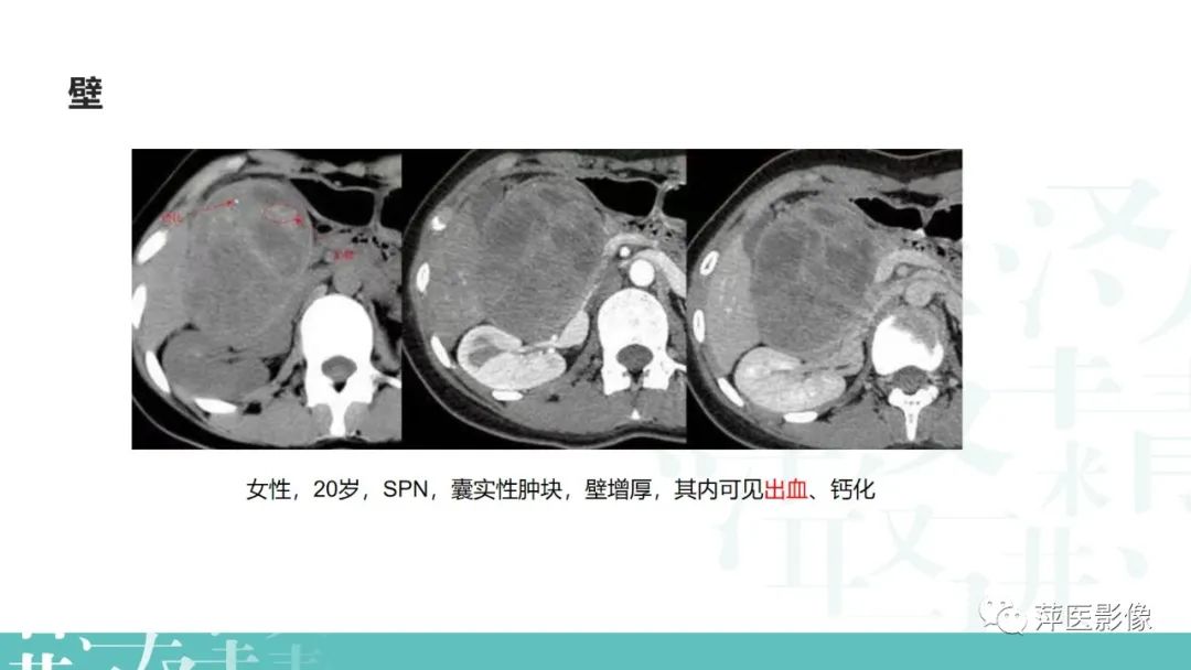 影像PPT - 【PPT】胰腺囊性肿瘤中的“老爷子”（IPMN）及诊断思路-29