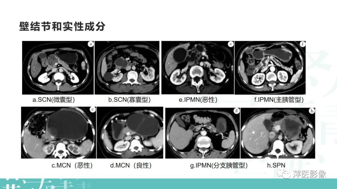 影像PPT - 【PPT】胰腺囊性肿瘤中的“老爷子”（IPMN）及诊断思路-32