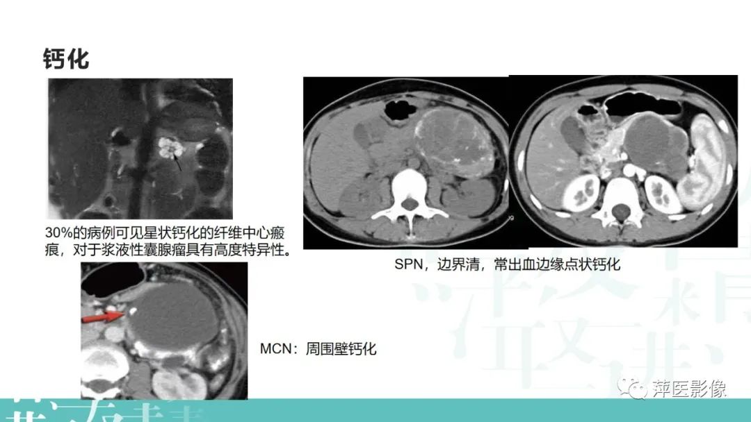 影像PPT - 【PPT】胰腺囊性肿瘤中的“老爷子”（IPMN）及诊断思路-34