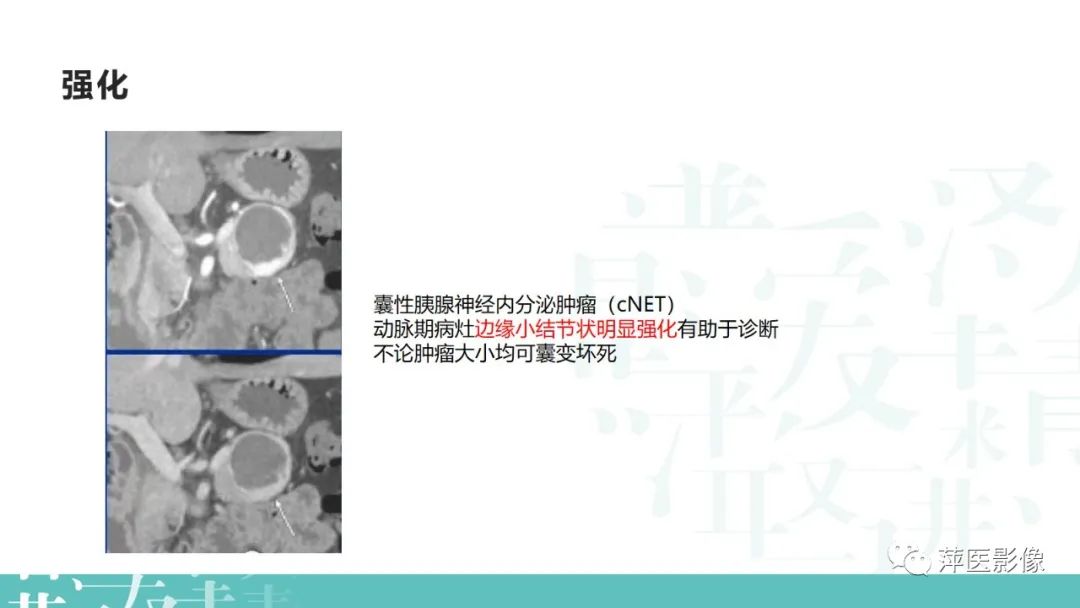 影像PPT - 【PPT】胰腺囊性肿瘤中的“老爷子”（IPMN）及诊断思路-36