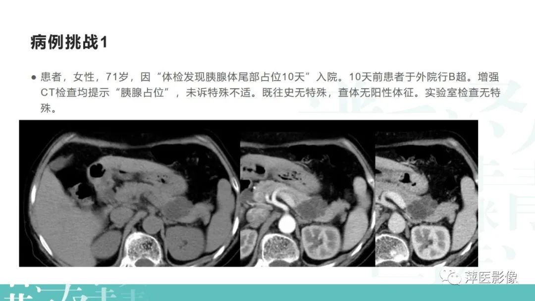 影像PPT - 【PPT】胰腺囊性肿瘤中的“老爷子”（IPMN）及诊断思路-38