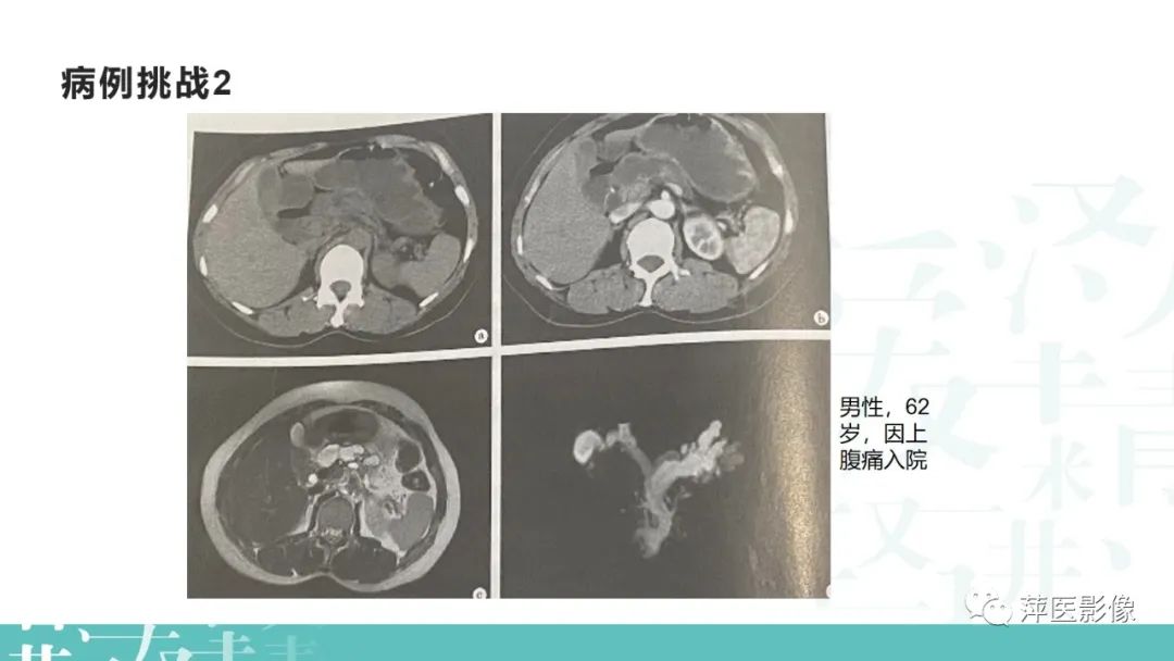 影像PPT - 【PPT】胰腺囊性肿瘤中的“老爷子”（IPMN）及诊断思路-39
