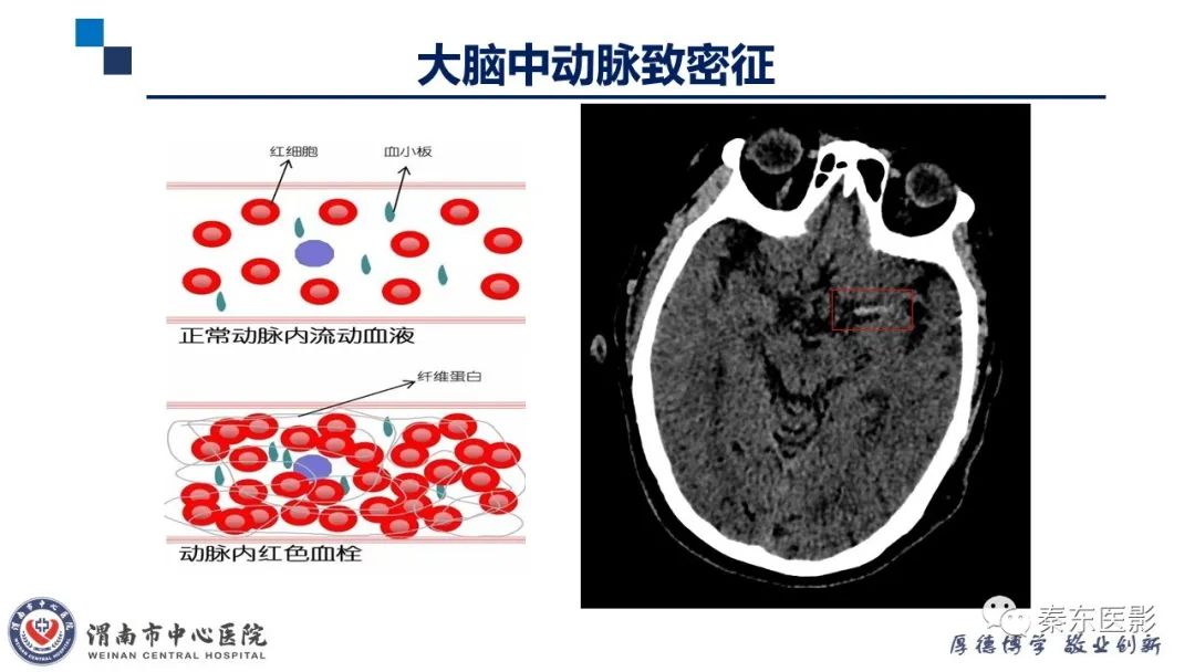 影像PPT - 【PPT】“大”有不同—缺血性脑卒中和卒中样发作病变的影像学诊断-5