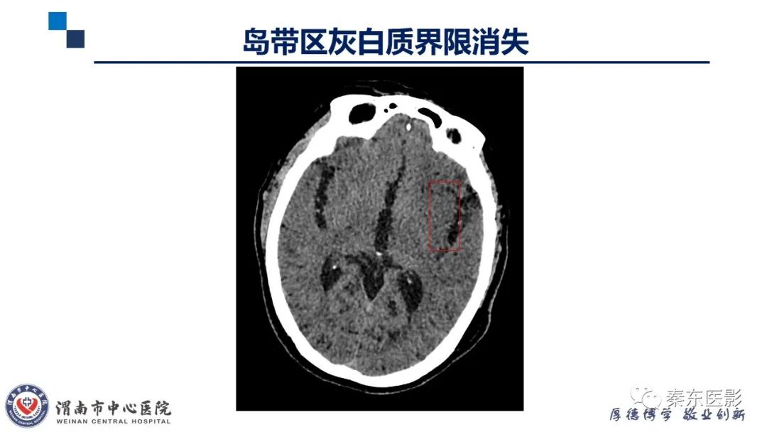 影像PPT - 【PPT】“大”有不同—缺血性脑卒中和卒中样发作病变的影像学诊断-6