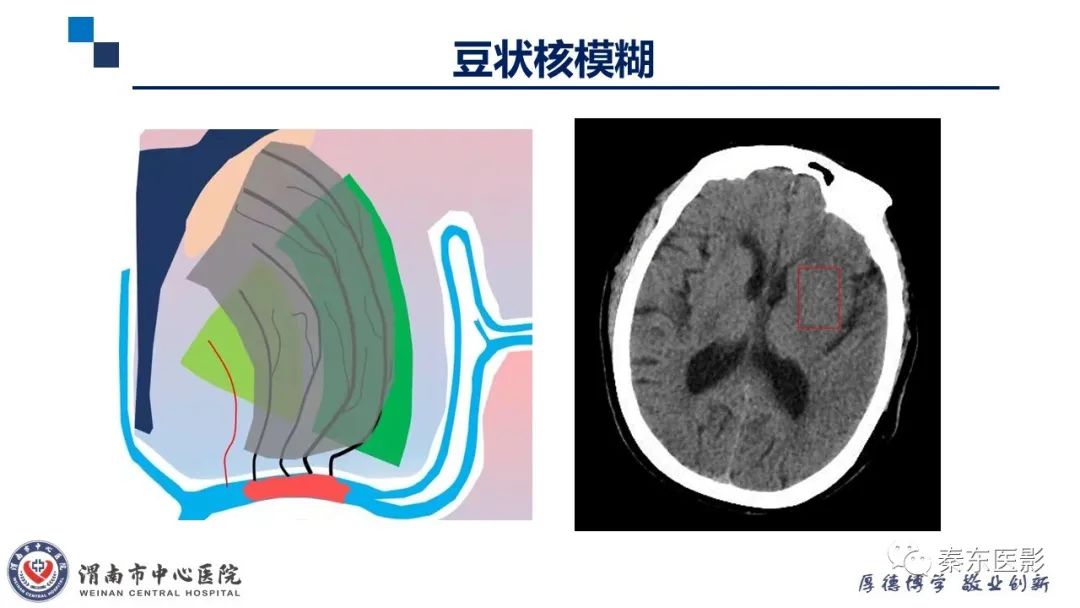 影像PPT - 【PPT】“大”有不同—缺血性脑卒中和卒中样发作病变的影像学诊断-7