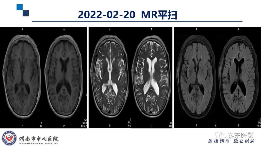影像PPT - 【PPT】“大”有不同—缺血性脑卒中和卒中样发作病变的影像学诊断-8