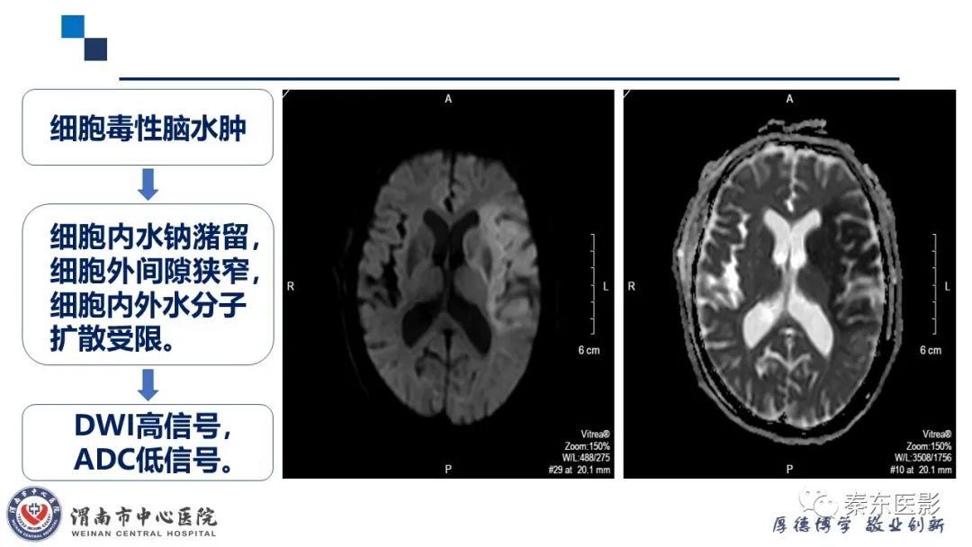 影像PPT - 【PPT】“大”有不同—缺血性脑卒中和卒中样发作病变的影像学诊断-11