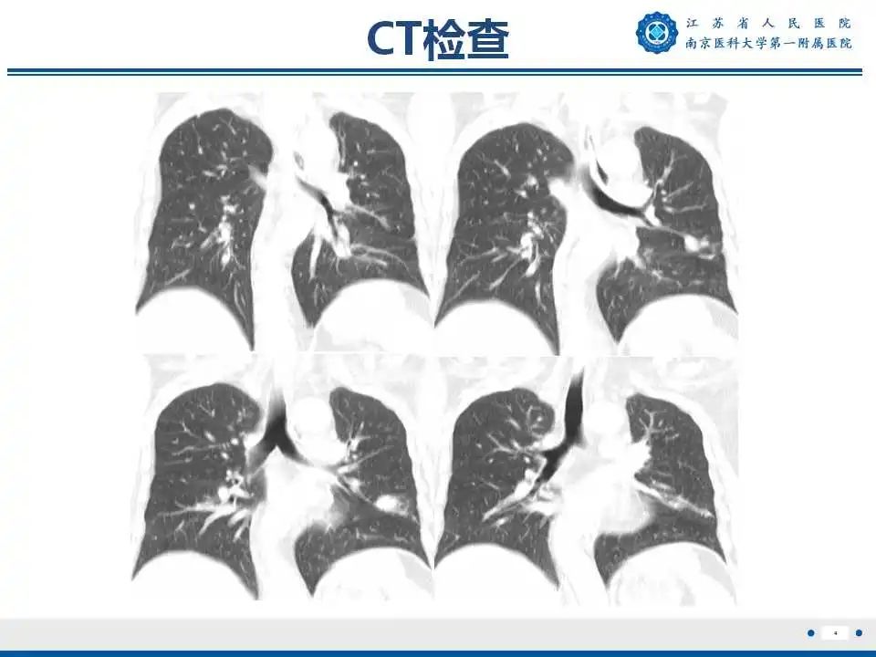 影像PPT - 【PPT】肺曲霉菌病-5