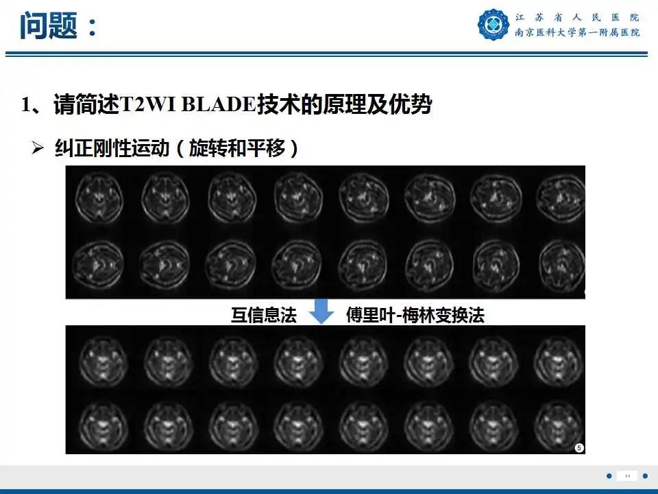 影像PPT - 【PPT】肺曲霉菌病-12