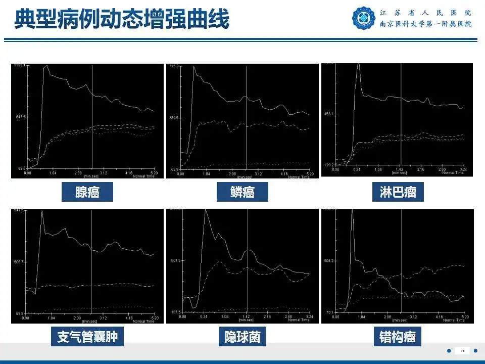 影像PPT - 【PPT】肺曲霉菌病-16