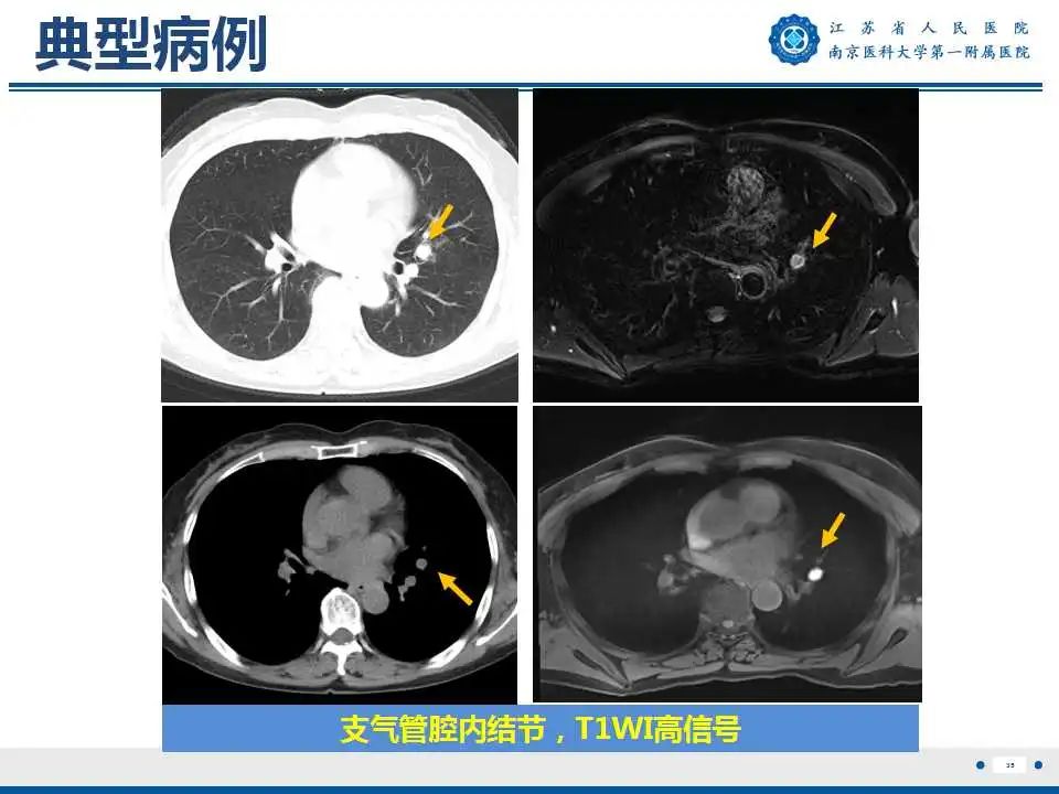 影像PPT - 【PPT】肺曲霉菌病-36
