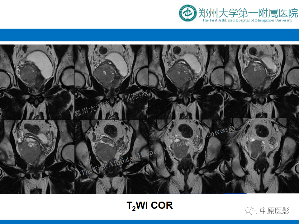 影像PPT - 【病例】前列腺滑膜肉瘤1例MR影像-6