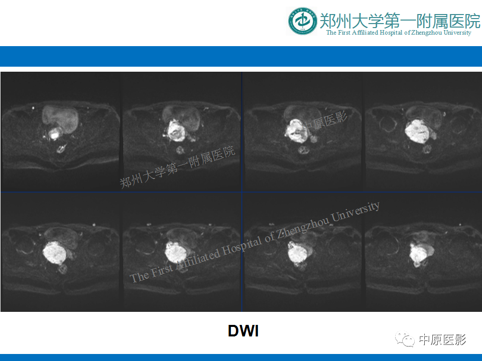 影像PPT - 【病例】前列腺滑膜肉瘤1例MR影像-7