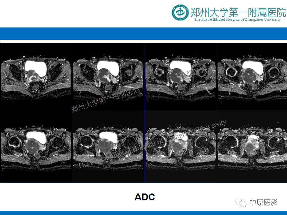 影像PPT - 【病例】前列腺滑膜肉瘤1例MR影像-8