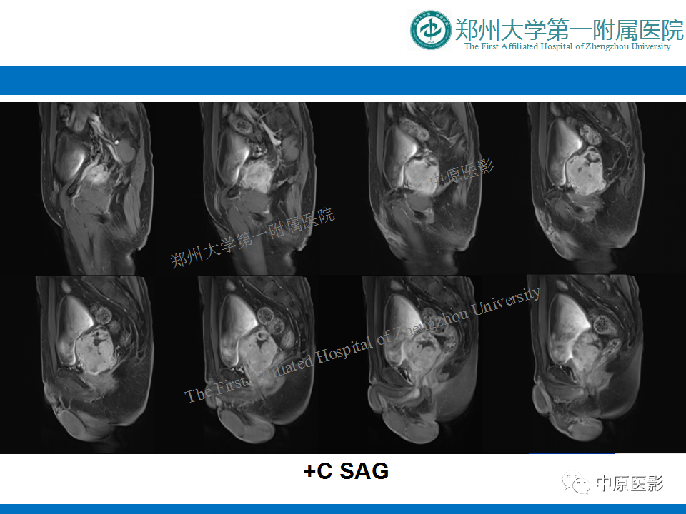 影像PPT - 【病例】前列腺滑膜肉瘤1例MR影像-10