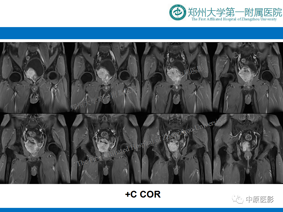 影像PPT - 【病例】前列腺滑膜肉瘤1例MR影像-11