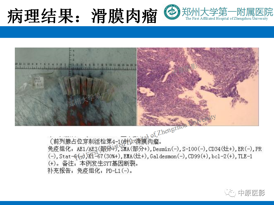 影像PPT - 【病例】前列腺滑膜肉瘤1例MR影像-13