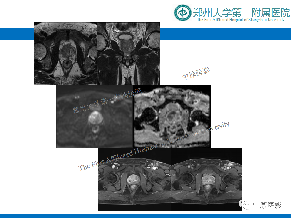 影像PPT - 【病例】前列腺滑膜肉瘤1例MR影像-18