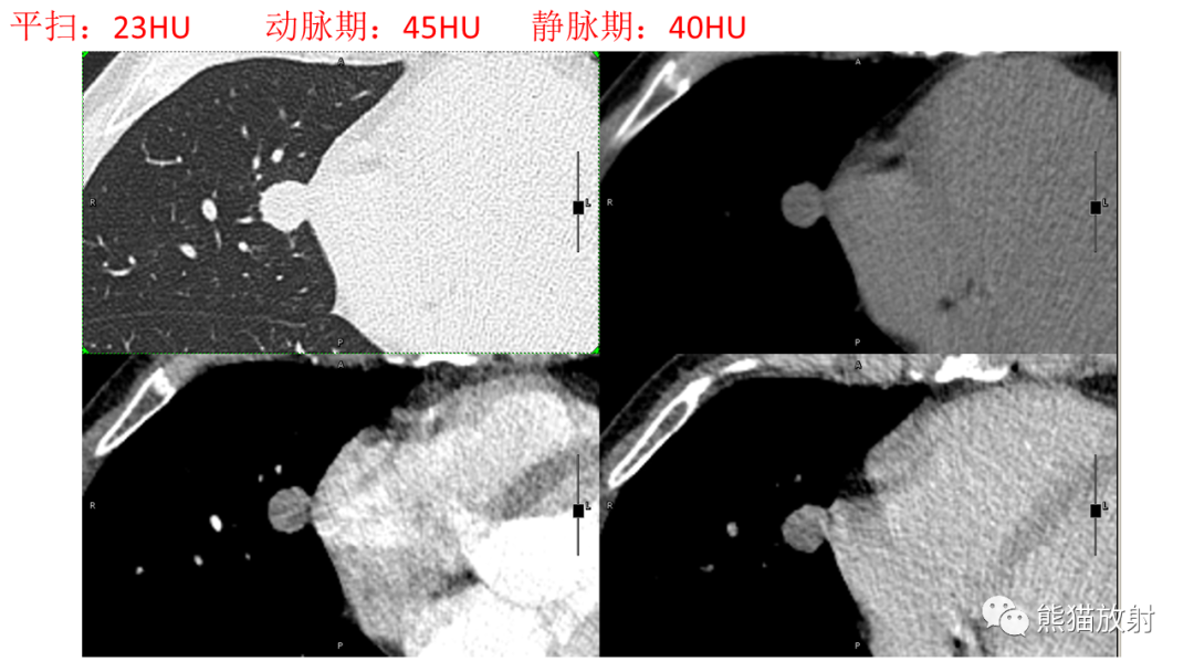 影像PPT - 【病例】肺腺癌 VS 炎性肌纤维母细胞瘤-6