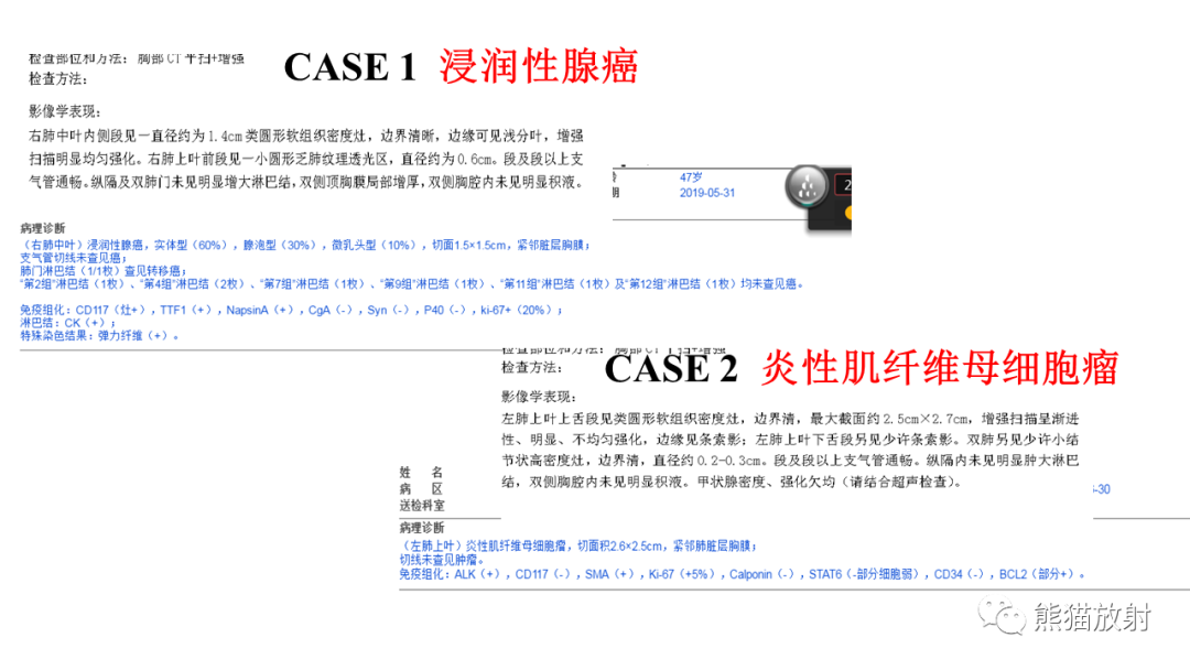 影像PPT - 【病例】肺腺癌 VS 炎性肌纤维母细胞瘤-14