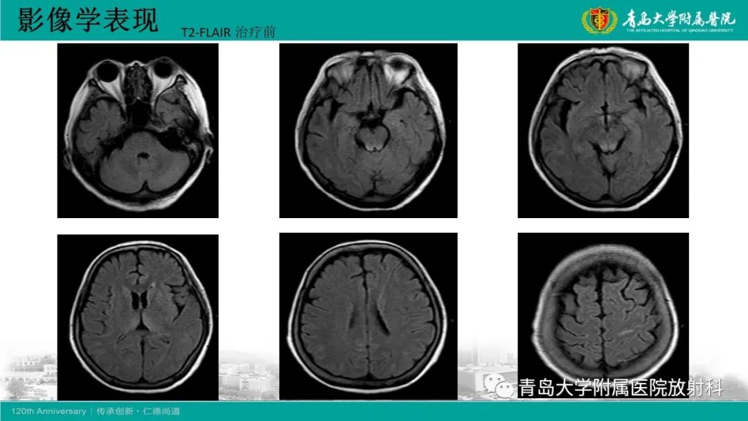 影像PPT - 【病例】Wernicke脑病1例MR影像-5