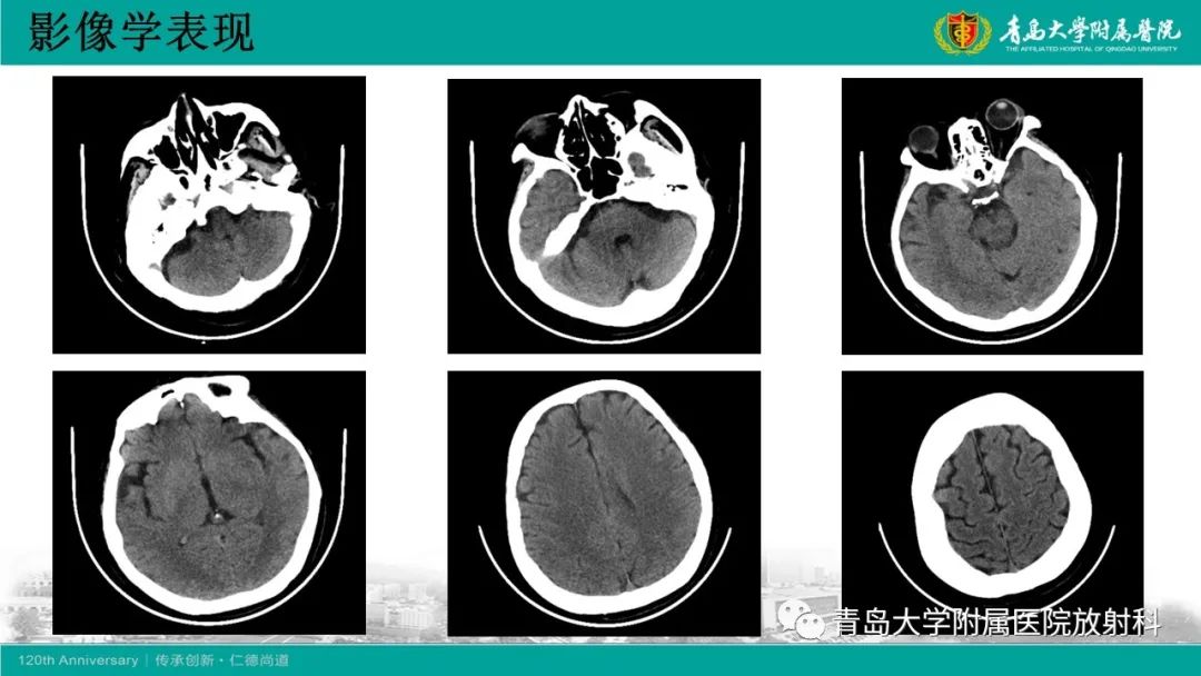 影像PPT - 【病例】Wernicke脑病1例MR影像-4