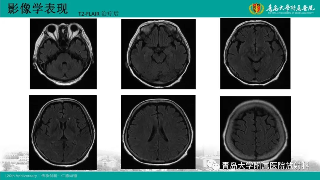 影像PPT - 【病例】Wernicke脑病1例MR影像-6