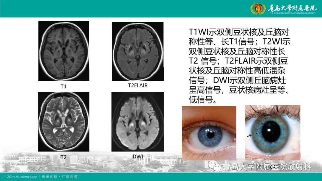 影像PPT - 【病例】Wernicke脑病1例MR影像-19