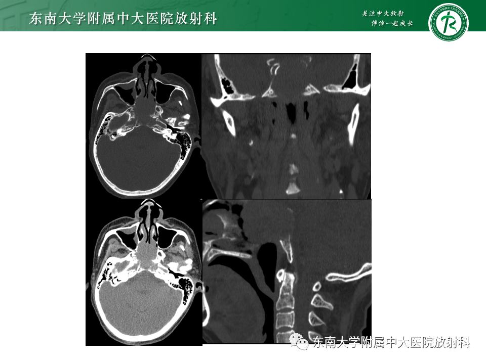影像PPT - 【PPT】斜坡骨质破坏性病变影像诊断-5