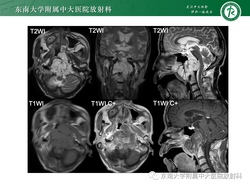影像PPT - 【PPT】斜坡骨质破坏性病变影像诊断-3