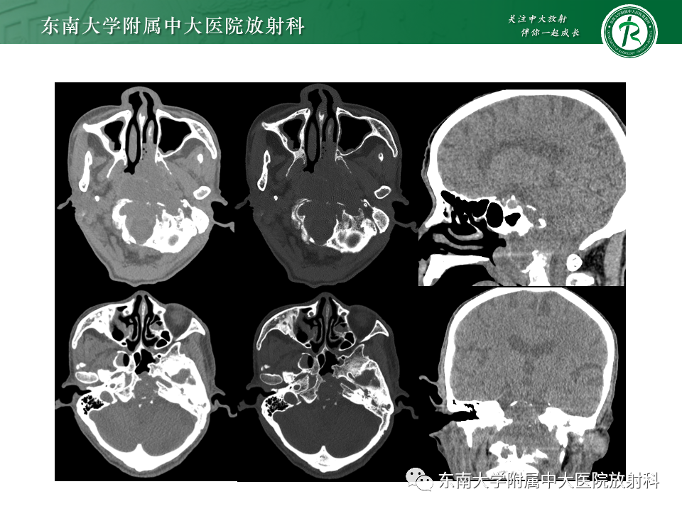 影像PPT - 【PPT】斜坡骨质破坏性病变影像诊断-2