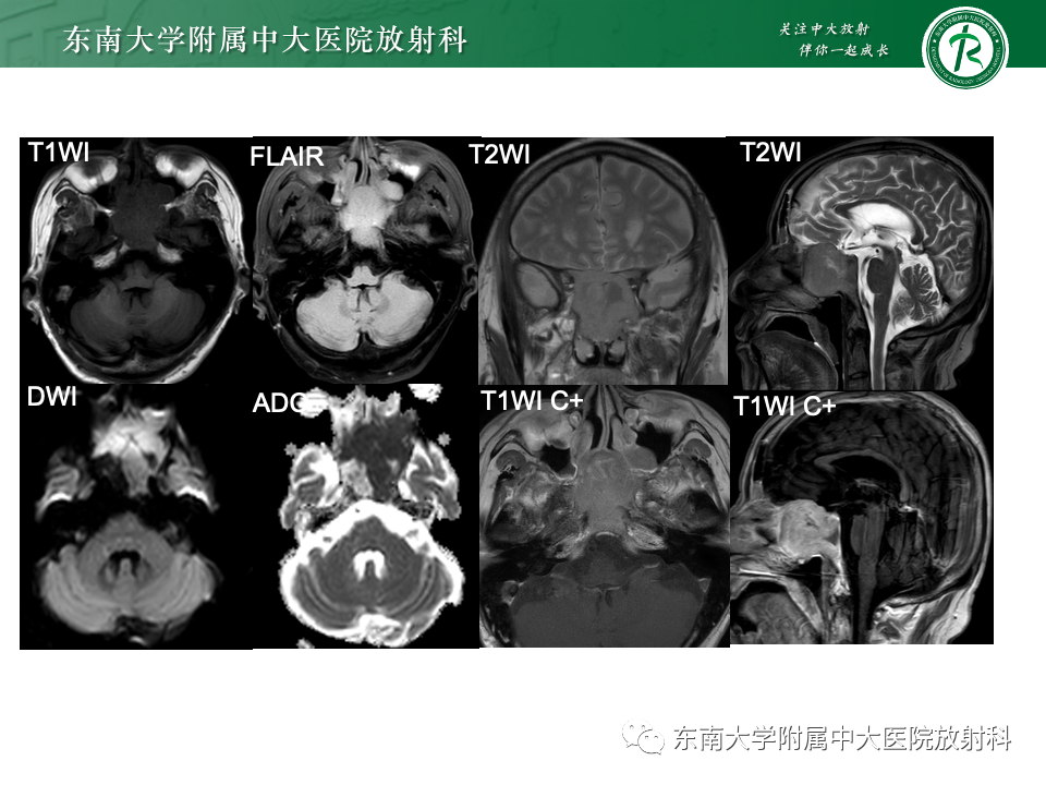 影像PPT - 【PPT】斜坡骨质破坏性病变影像诊断-6