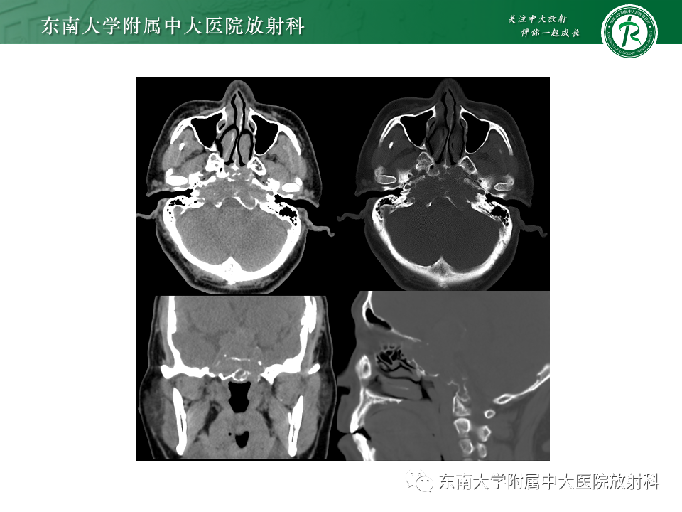 影像PPT - 【PPT】斜坡骨质破坏性病变影像诊断-8